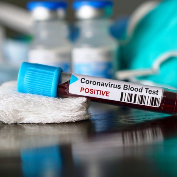 Συνεχίζεται η έρευνα για Covid 19 από Πανεπιστήμιο Πατρών