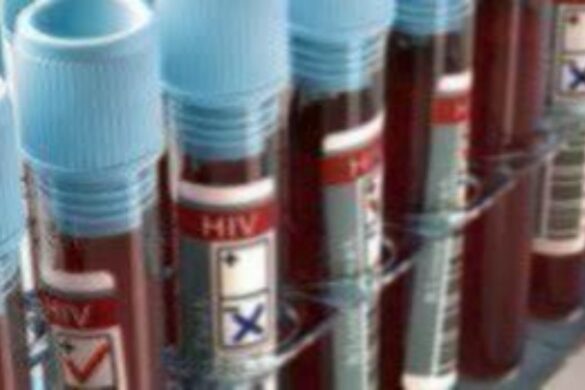 AIDS: Οι περικοπές στη διεθνή βοήθεια που παρέχουν οι ΗΠΑ κινδυνεύουν να γυρίσουν τον κόσμο 20 χρόνια πίσω
