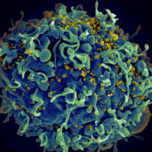 HIV: Φάρμακο για τον καρκίνο ίσως ανοίγει το δρόμο για πλήρη ίαση του ιού